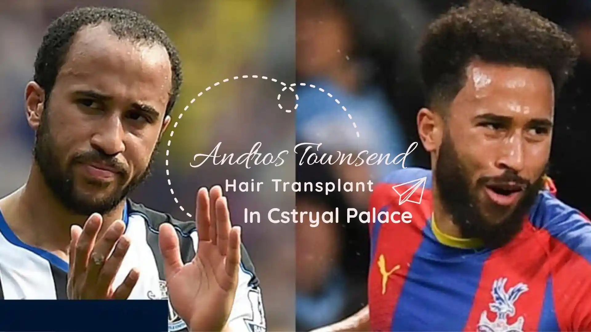 Andros Townsend Hair Transplant In Cstryal Palace