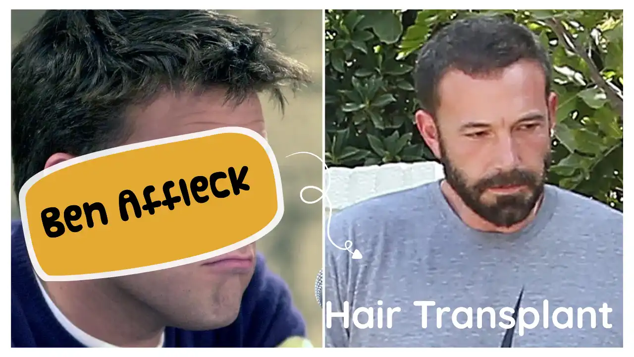 Ben Affleck Hair Transplant
