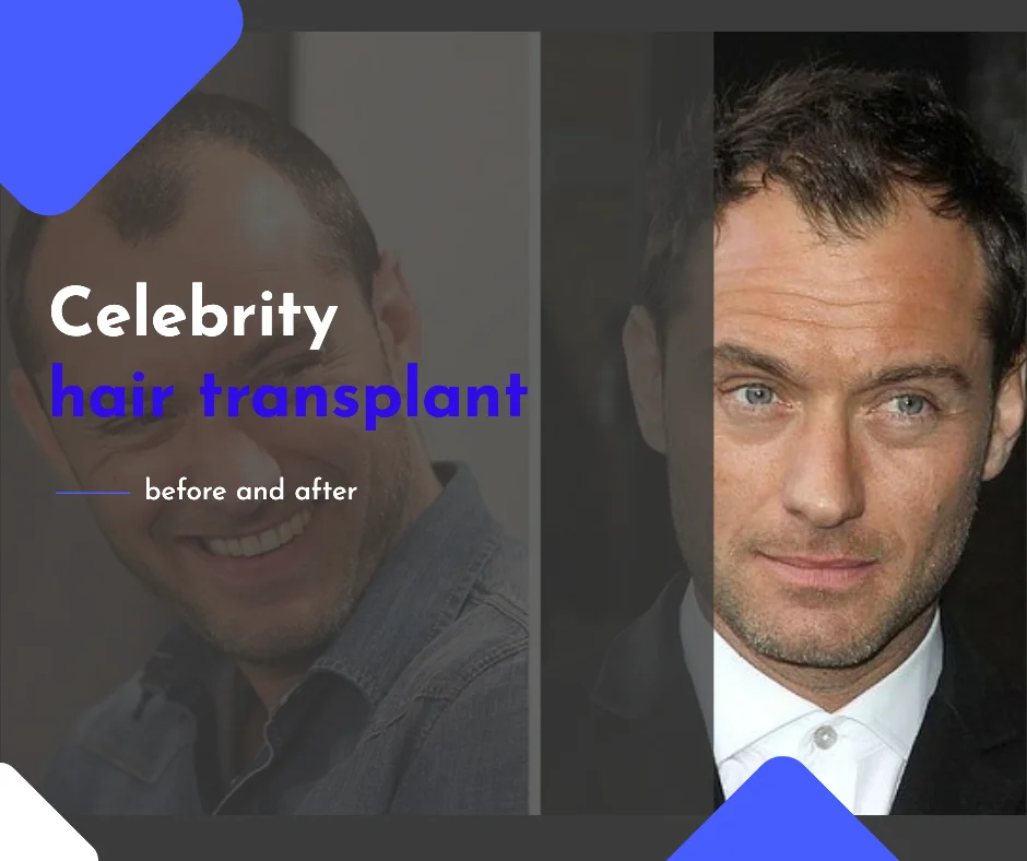 Celebrity hair transplant before and after