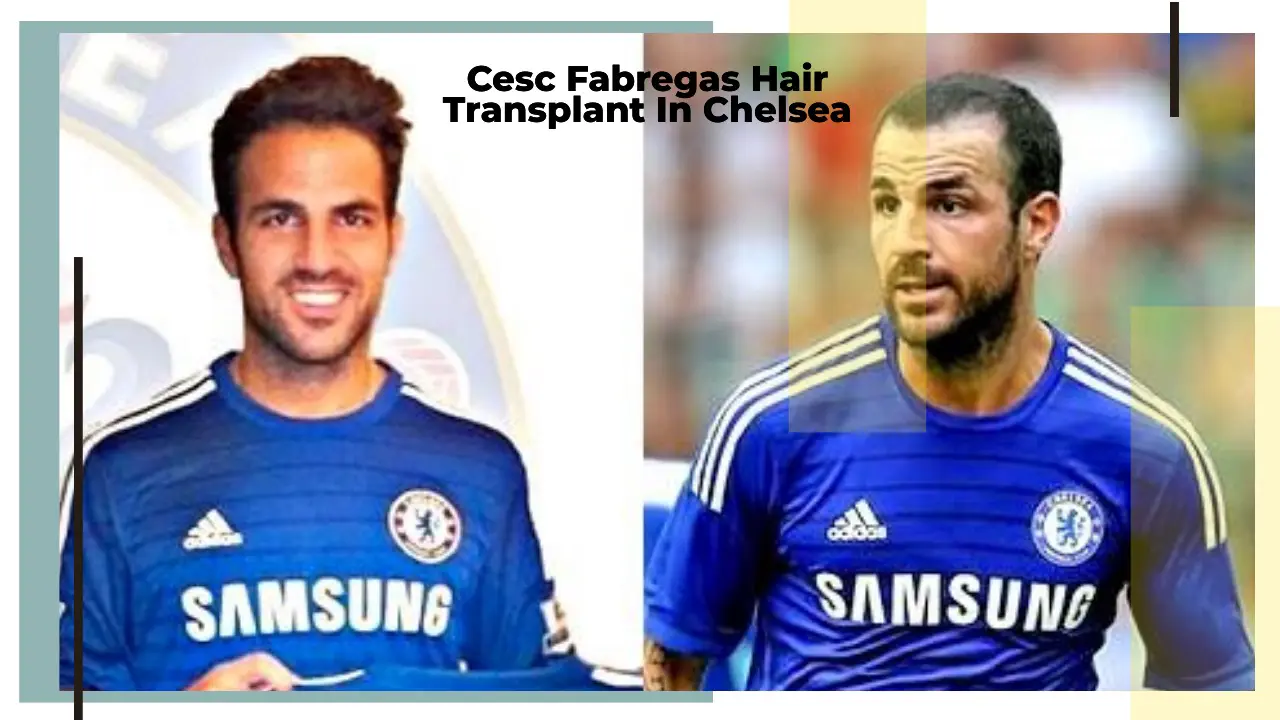 Cesc Fabregas Hair Transplant In Chelsea