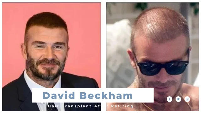 David Beckham Hair Transplant After Retiring