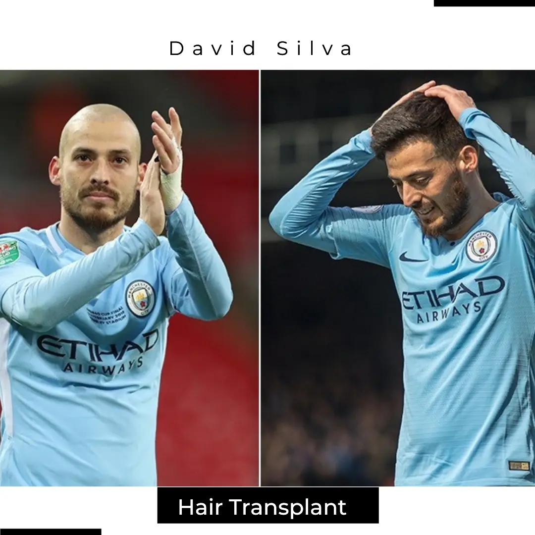 David Silva Hair Transplant In Manchester City