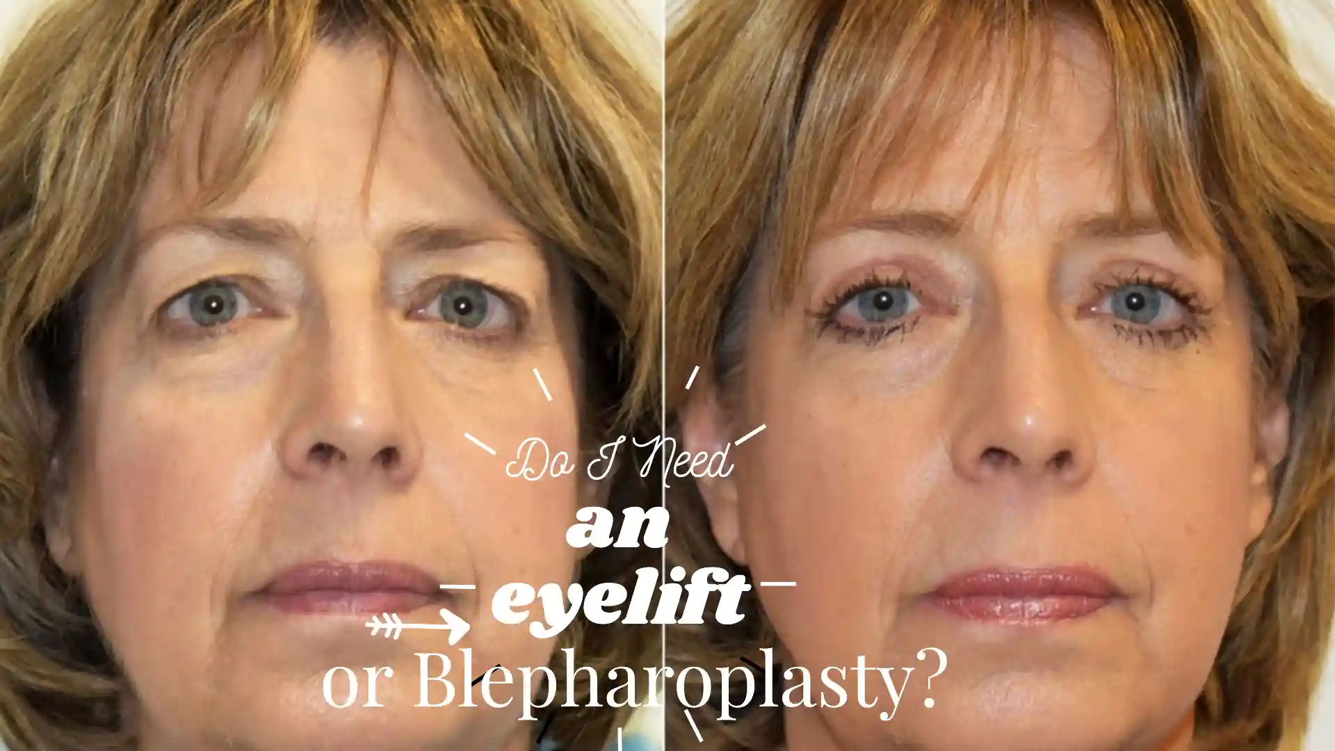 Do I Need an eyelift or Blepharoplasty?