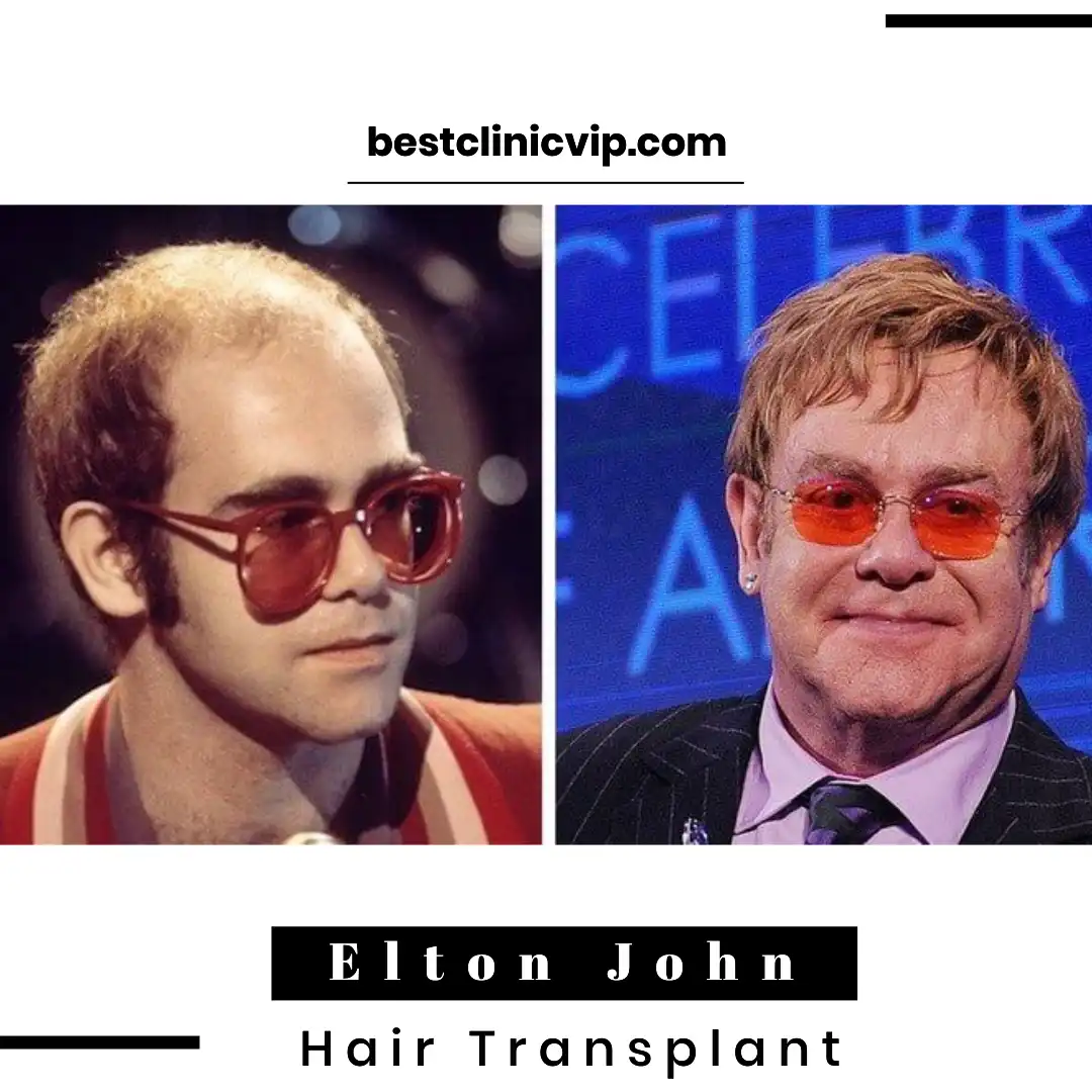 Elton John Hair Transplant