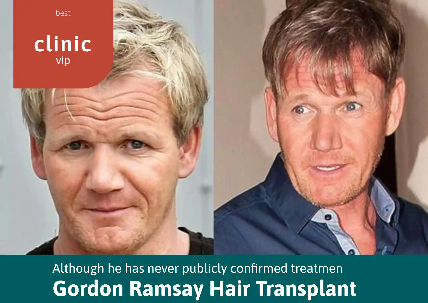 Gordon Ramsay Hair Transplant