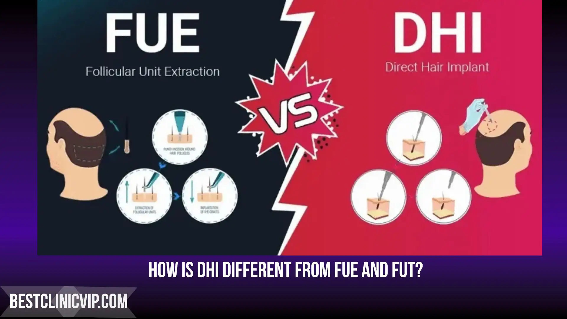 How is DHI different from FUE and FUT