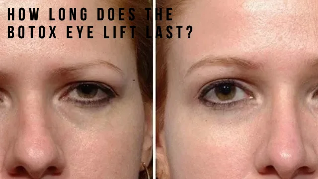 How long does the Botox eye lift last