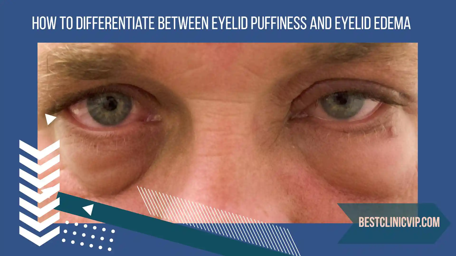 How to Differentiate Between Eyelid Puffiness and Eyelid Edema