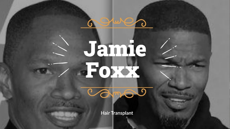 Jamie Foxx Hair Transplant