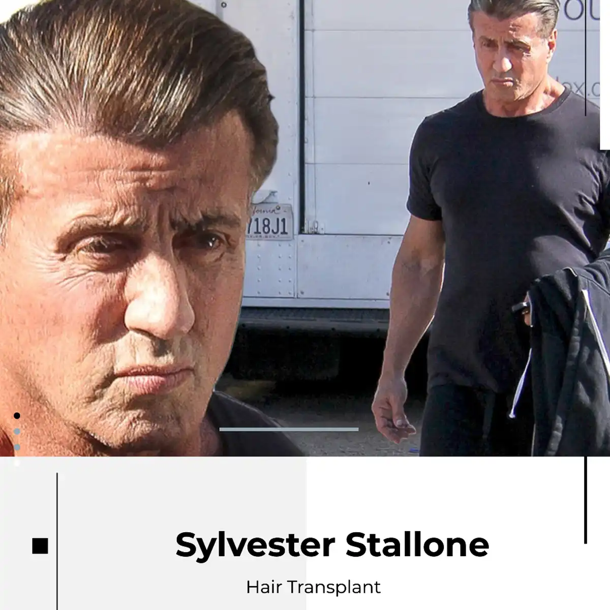 Sylvester Stallone Hair Transplant