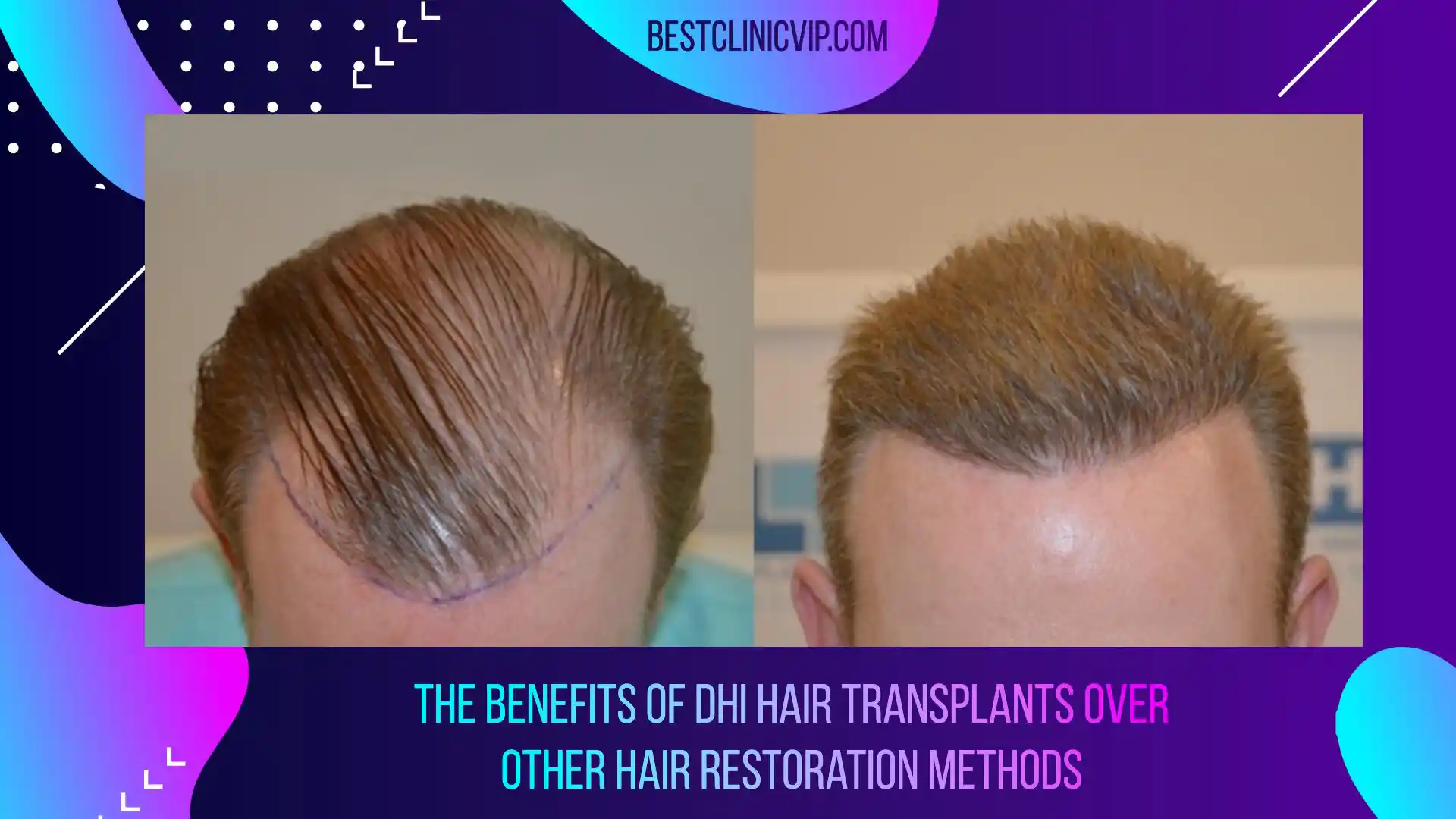 The benefits of DHI hair transplants over other hair restoration methods