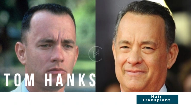 Tom Hanks hair transplant