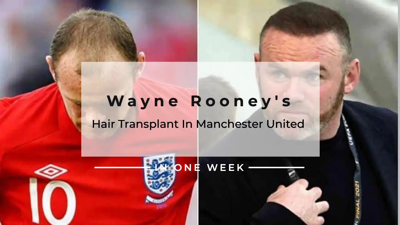 Wayne Rooney's Hair Transplant In Manchester United
