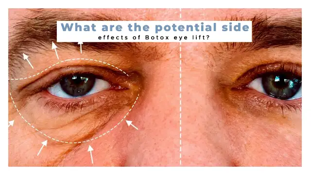 What are the potential side effects of Botox eye lift?