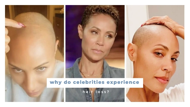 why do celebrities experience hair loss?