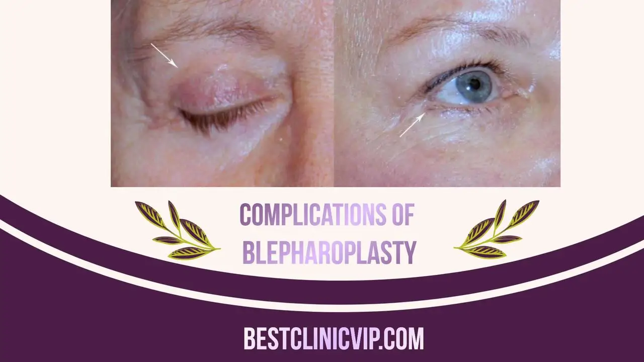 Understanding the Risks: Potential Complications of Blepharoplasty