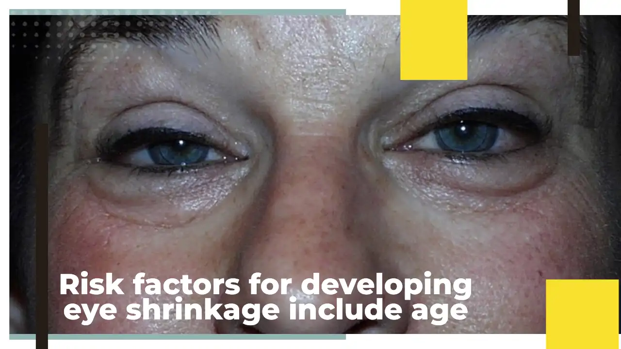 Risk factors for developing eye shrinkage include age