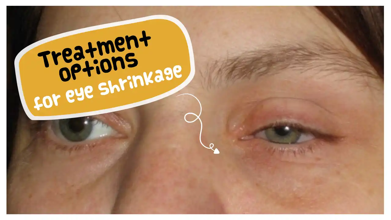 Treating Eye Shrinkage After Blepharoplasty: Finding the Right Solution for You