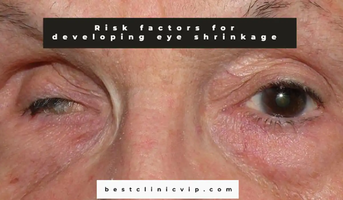 "Eye Shrinkage After Blepharoplasty: Identifying Risk Factors and Preventative Measures