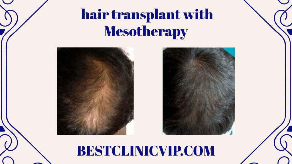 Mesotherapy: Enhancing Hair Transplant Results