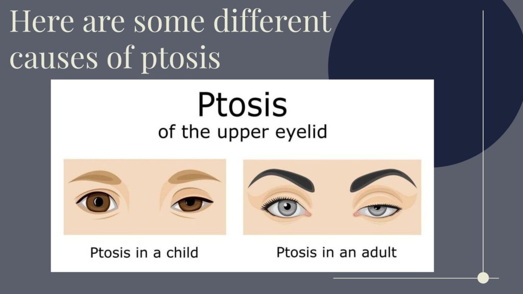 Here are some different causes of ptosis